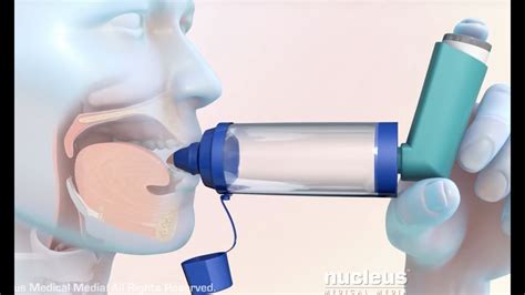Inhaler Spacer Benefits