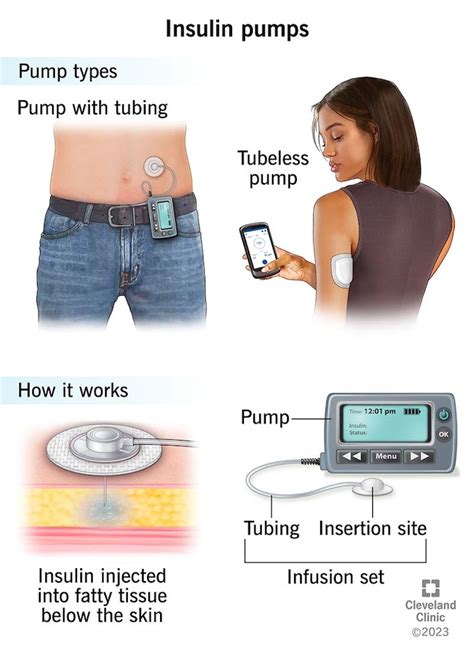 Insulin Pumps