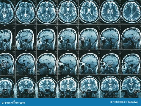 Interpreting MRI Of The Head Results