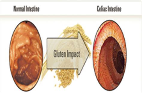 Intestinal Biopsy in Gluten Enteropathy Diagnosis