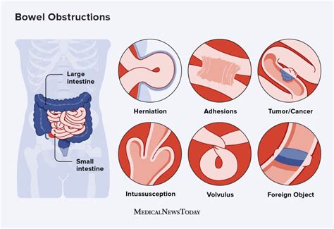 Intestinal Blockage Causes
