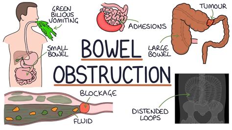 Intestinal Blockage Symptoms