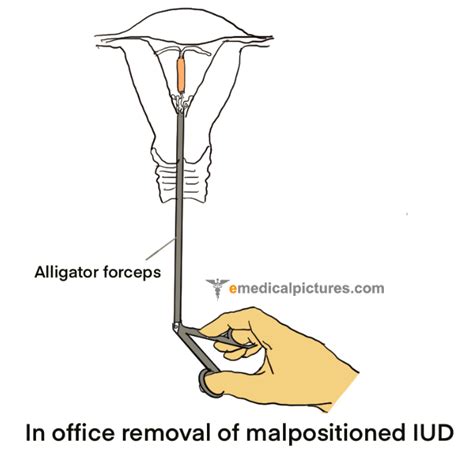Intrauterine Device Removal