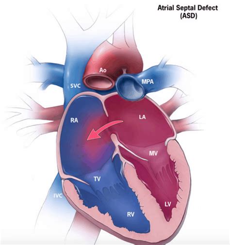 Introduction to ASD and Heart Defects
