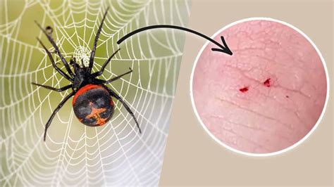 Introduction to Black Widow Spider Bites