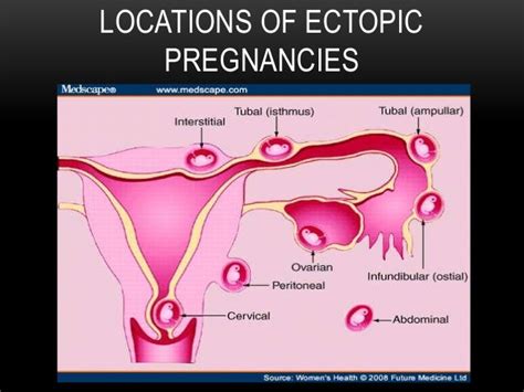 Introduction to Ectopic Pregnancy