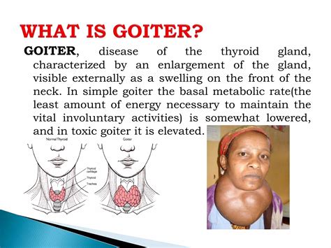 Introduction to Goiter Disease