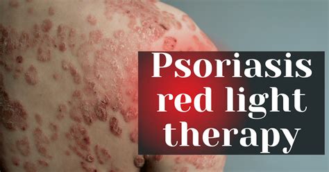 Introduction to Psoriasis Light Therapy
