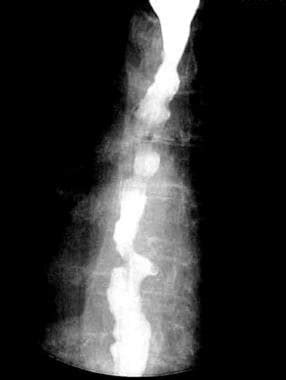Isosorbide for Esophageal Spasms