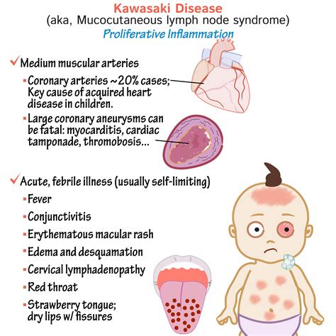 Kawasaki Disease Research