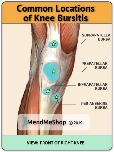 Knee Bursitis Overview