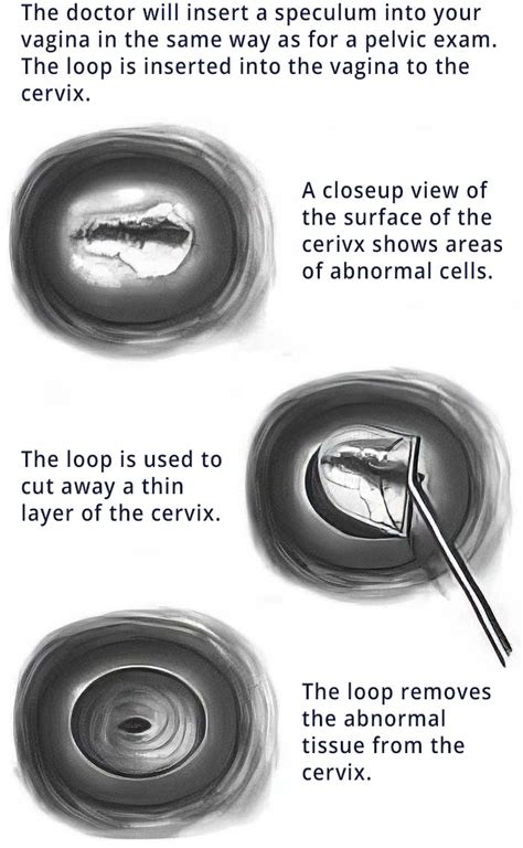 LEEP Procedure