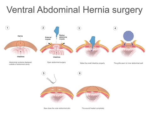 Laparoscopic Hernia Repair