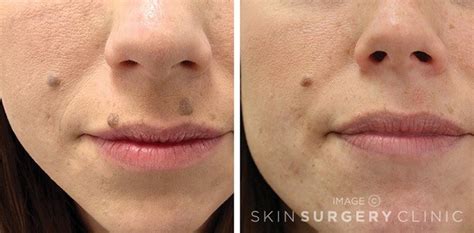 Laser Mole Removal