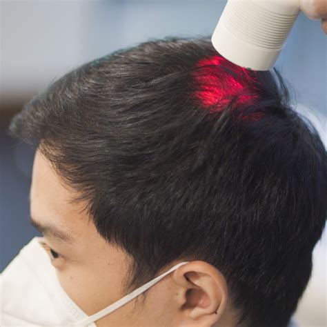 Laser Therapy for Hair Loss
