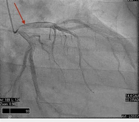 Left Heart Cath Procedure Works