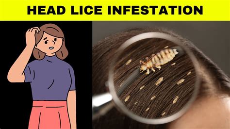 Lice Infestation Signs