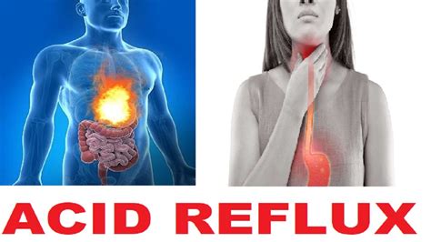 Lifestyle Changes for Acid Reflux