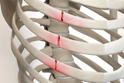 Lifestyle Modifications for Rib Fracture Care