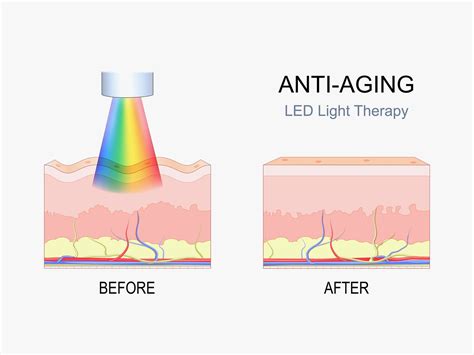 Common Misconceptions About Light Therapy