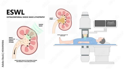 Lithotripsy Treatment Overview