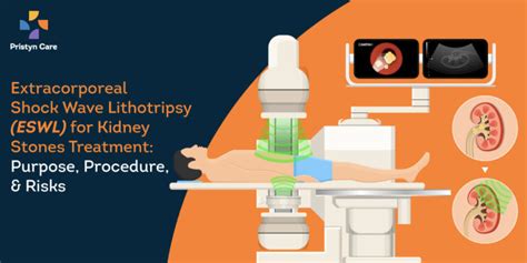 Lithotripsy Treatment Procedure