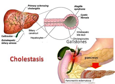 Living with Cholestasis