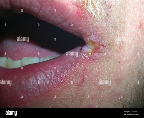 Living with Angular Stomatitis