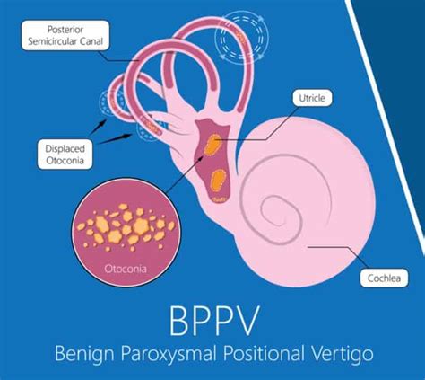 Living with BPPV