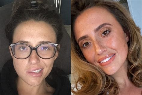 Living with Bells Palsy