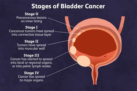 Living with Bladder Tumors