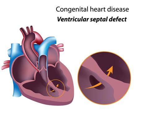 Living with Congenital Heart Holes