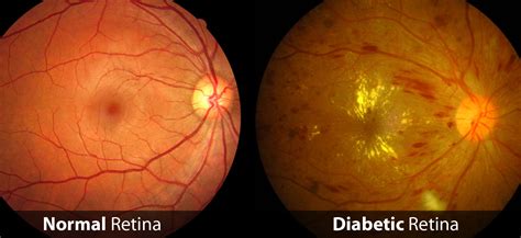 Living with Diabetic Retinopathy