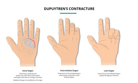 Living with Dupuytren's contracture