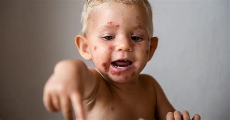 Living with Impetigo