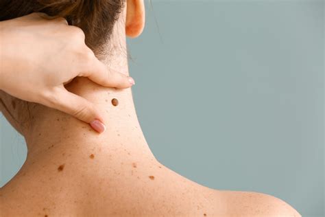 Living with Keratosis