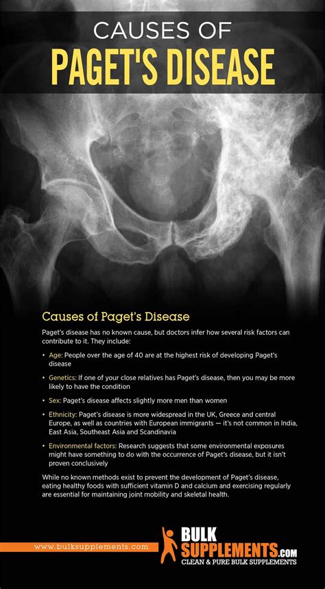 Living with Paget's Disease