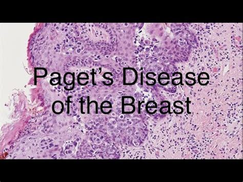Living with Paget's Disease of the Breast