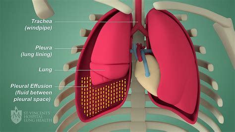 Living with Pleural Effusion