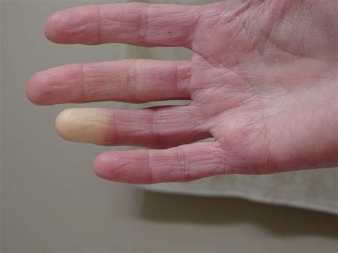 Living with Raynaud's Disease
