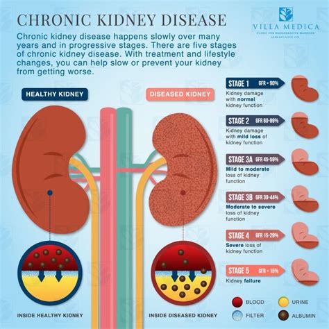 Living with Stage 3 Kidney Failure