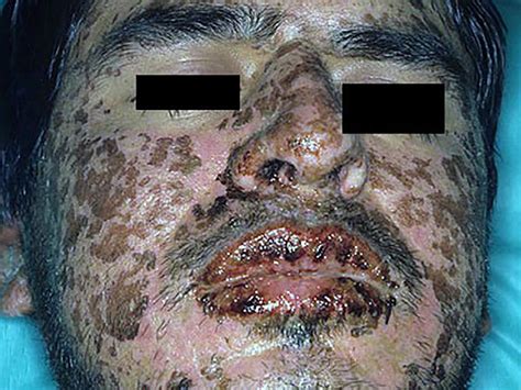 Living with Steven Johnson Syndrome