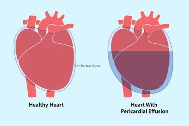 Living with a Small Pericardial Effusion