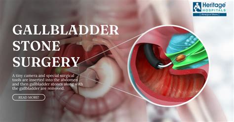 Long-Term Outlook After Gallstone Surgery