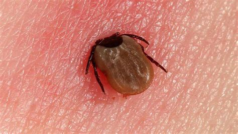 Lyme Disease