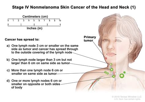 Lymph Node Cancer