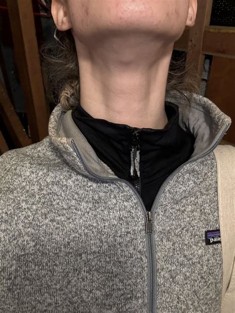 Lymph Node Swelling Under Chin
