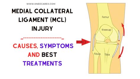 MCL Pain Causes