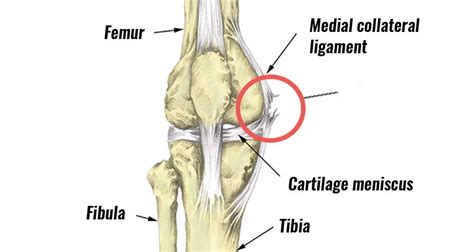 MCL Pain Summary