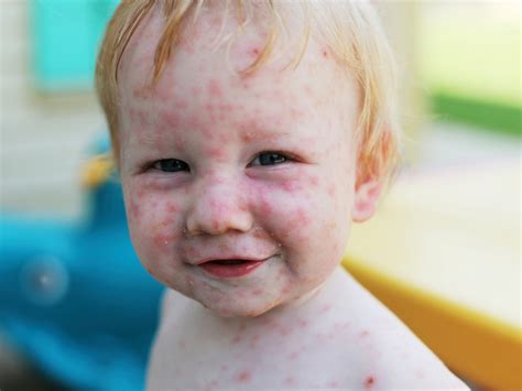 MMR Vaccine Rash Symptoms